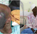Kenyan Doctors Remove 3kg Growth on Elderly Woman's Face, Ending 21 Years of Agony  