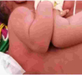 Kenyan Teenager Gives Birth to Conjoined Twins at Lenmek Hospital