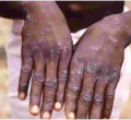 Health Ministry Says No Case of Monkeypox Recorded in Kenya