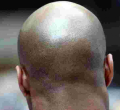  British Court Rules Calling a Man 'Bald' is Sexual Harassment