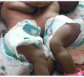 Kenyan Woman Appeals for Help After Giving Birth to Conjoined Twins