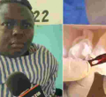 Doctors Remove a Scalpel Blade from Kenyan Woman’s Abdomen 11 Years After Surgery