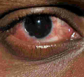 The Surge of Red Eye Disease in Kenya's Coast Region