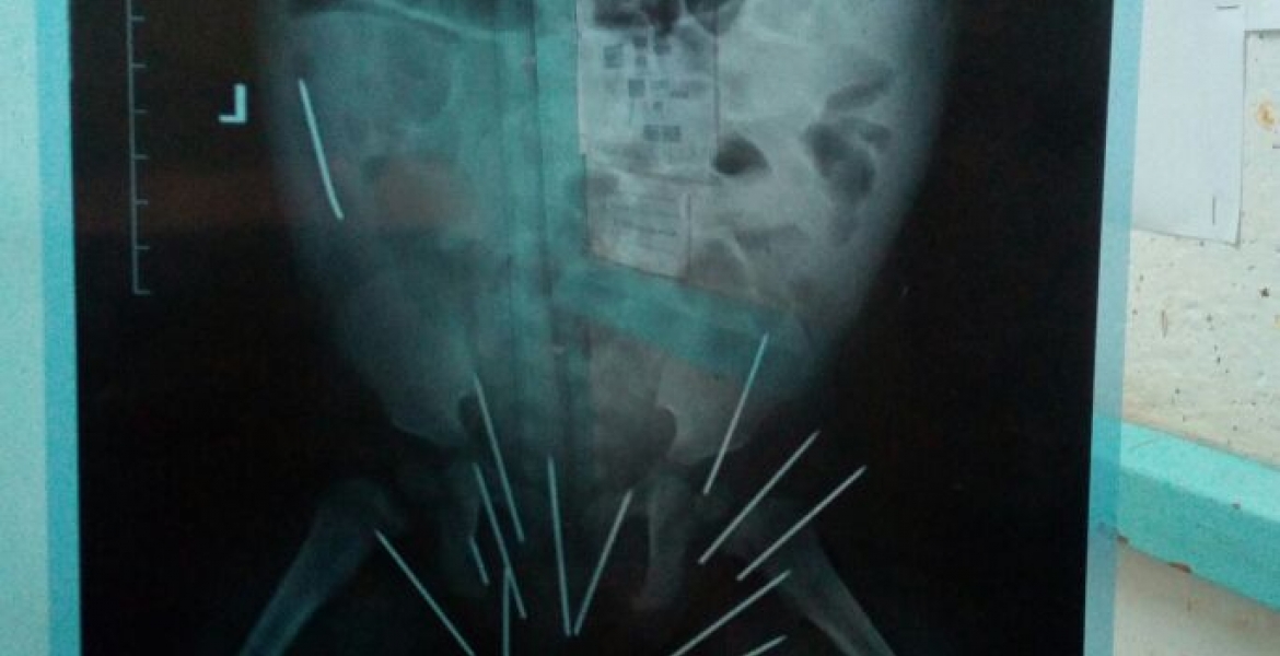 Medics at Thika Level 5 Hospital Remove 13 Needles from 10-Month-Old Girl