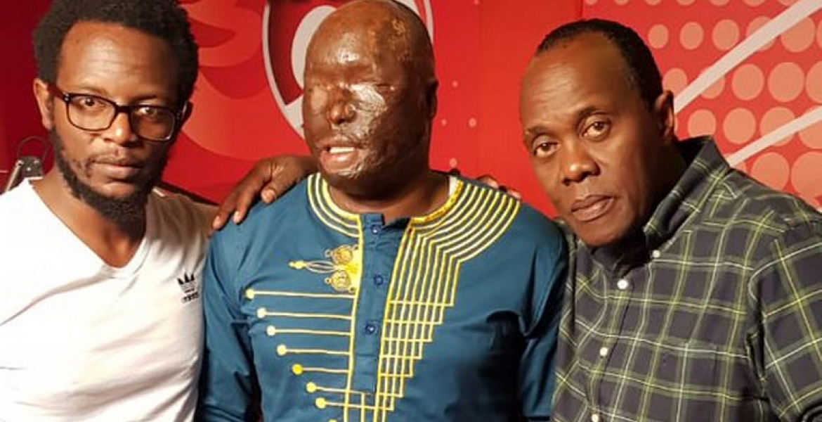 Kenyan Police Officer Narrates How His Wife Attacked Him with Surphuric Acid While Sleeping