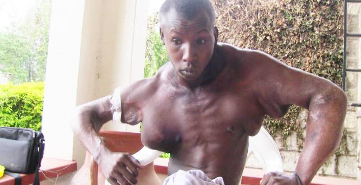 Kenyan Man with Abnormal Swelling in Chest, Arms Seeks Help to Get Live-Saving Surgery