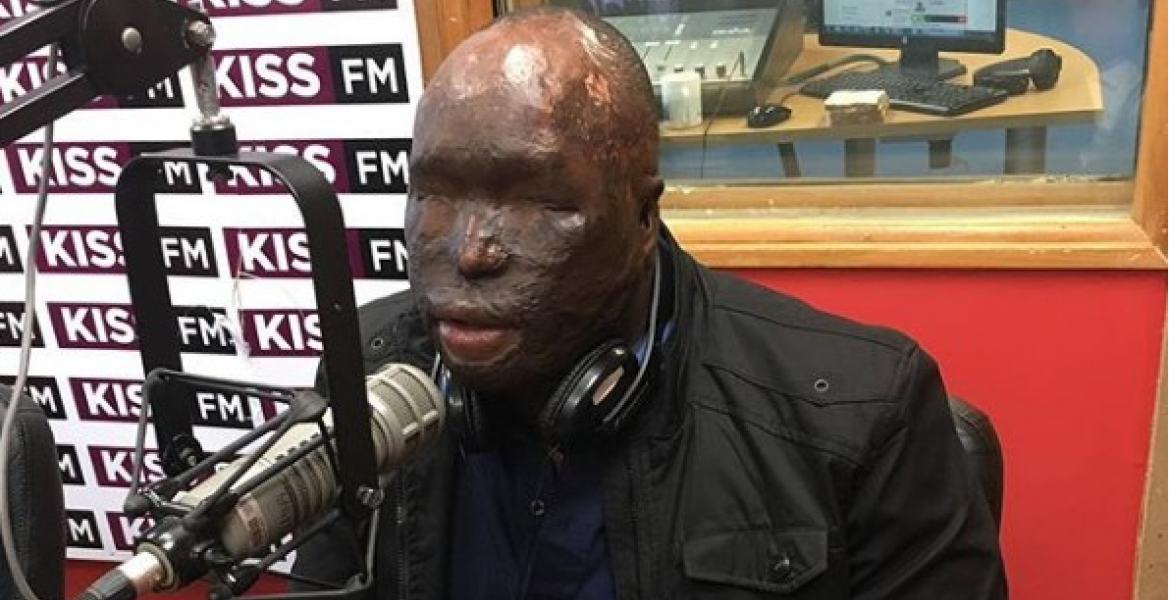 Kenyan Man Attacked with Acid by Wife Arrives in US for Specialized Surgery
