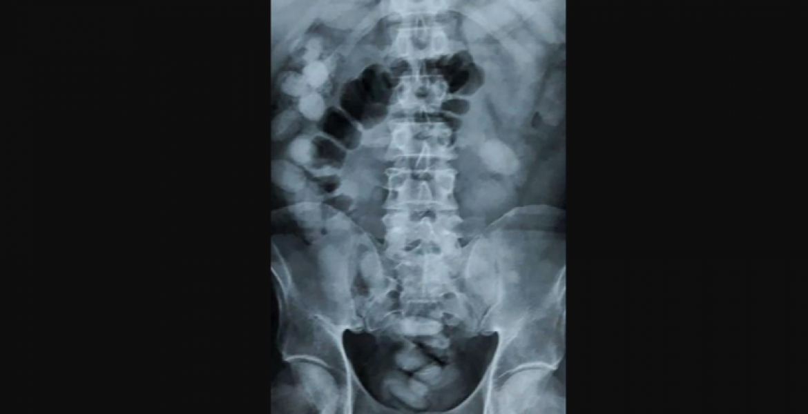 Thailand: Kenyan Woman Busted Carrying 1.2 Kilos of Cocaine in Her Stomach