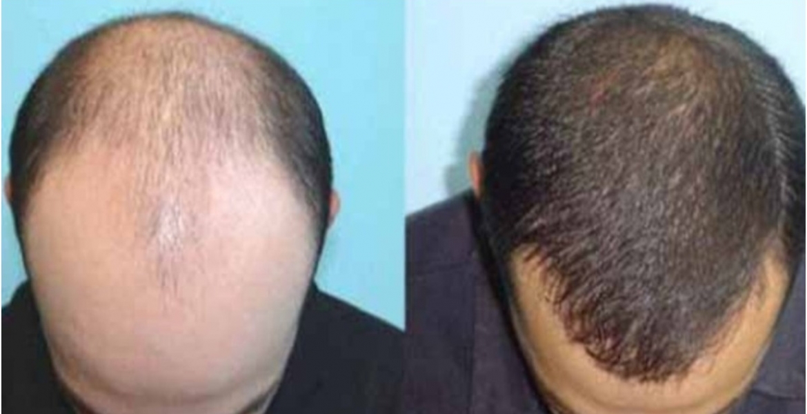 Hair Transplant Clinic Opened in Nairobi