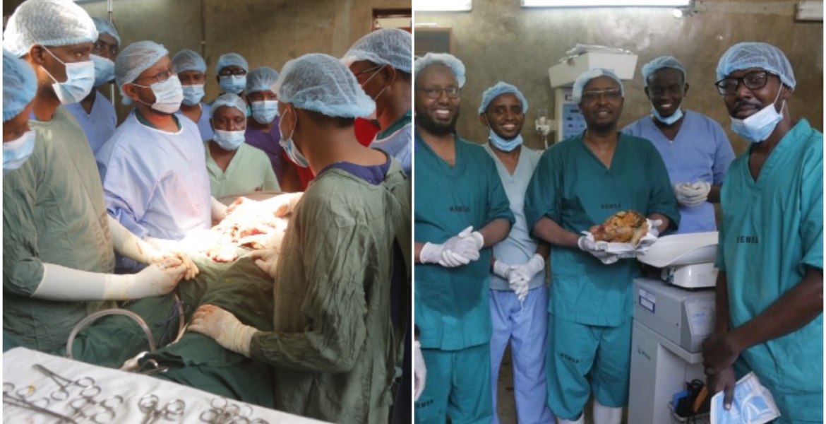 History as Kenyan Doctors Successfully Remove 13-Year-Old Stone Baby from Woman’s Abdomen