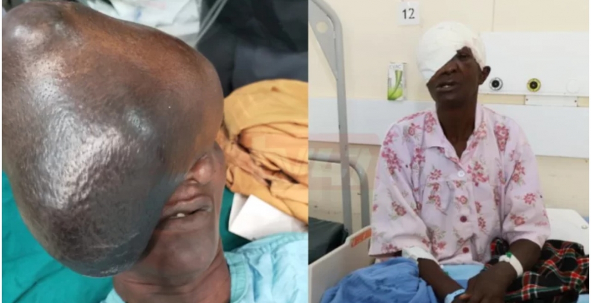 Kenyan Doctors Remove 3kg Growth on Elderly Woman's Face, Ending 21 Years of Agony