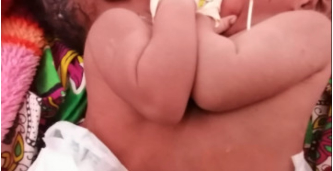 Kenyan Teenager Gives Birth to Conjoined Twins at Lenmek Hospital