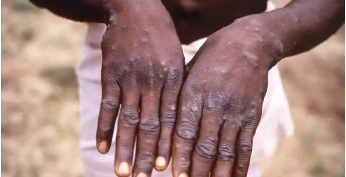 Health Ministry Says No Case of Monkeypox Recorded in Kenya