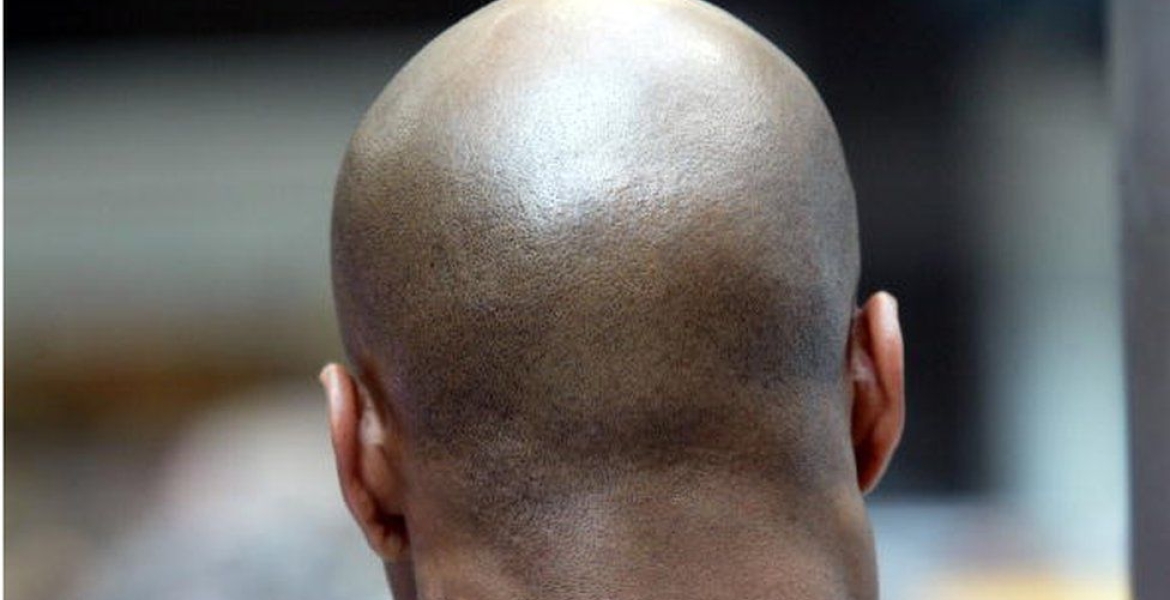 British Court Rules Calling a Man 'Bald' is Sexual Harassment