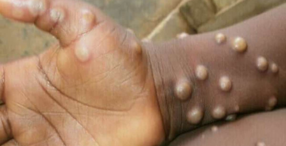 US Pharmaceutical Company Tonix to Conduct Monkeypox Vaccine Trials in Kenya
