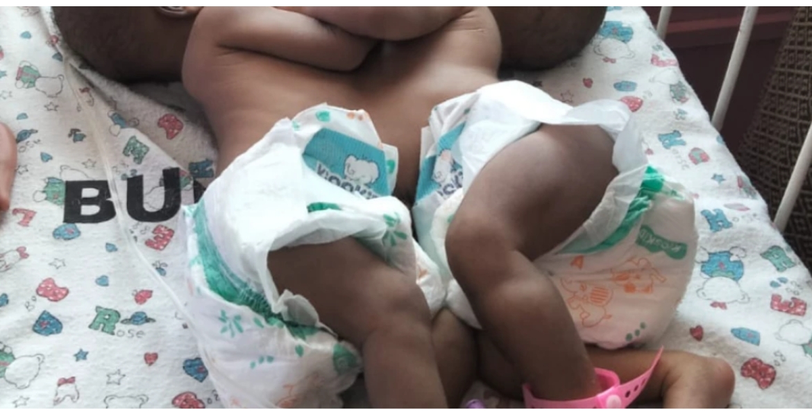 Kenyan Woman Appeals for Help After Giving Birth to Conjoined Twins