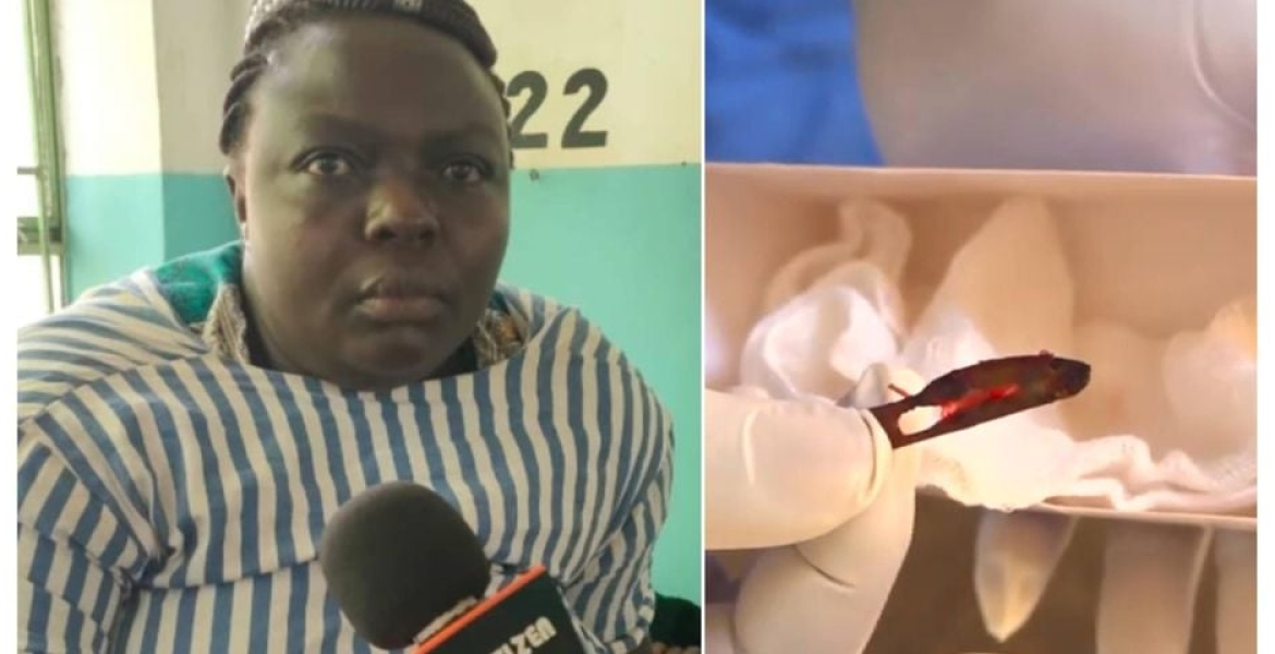 Doctors Remove a Scalpel Blade from Kenyan Woman’s Abdomen 11 Years After Surgery