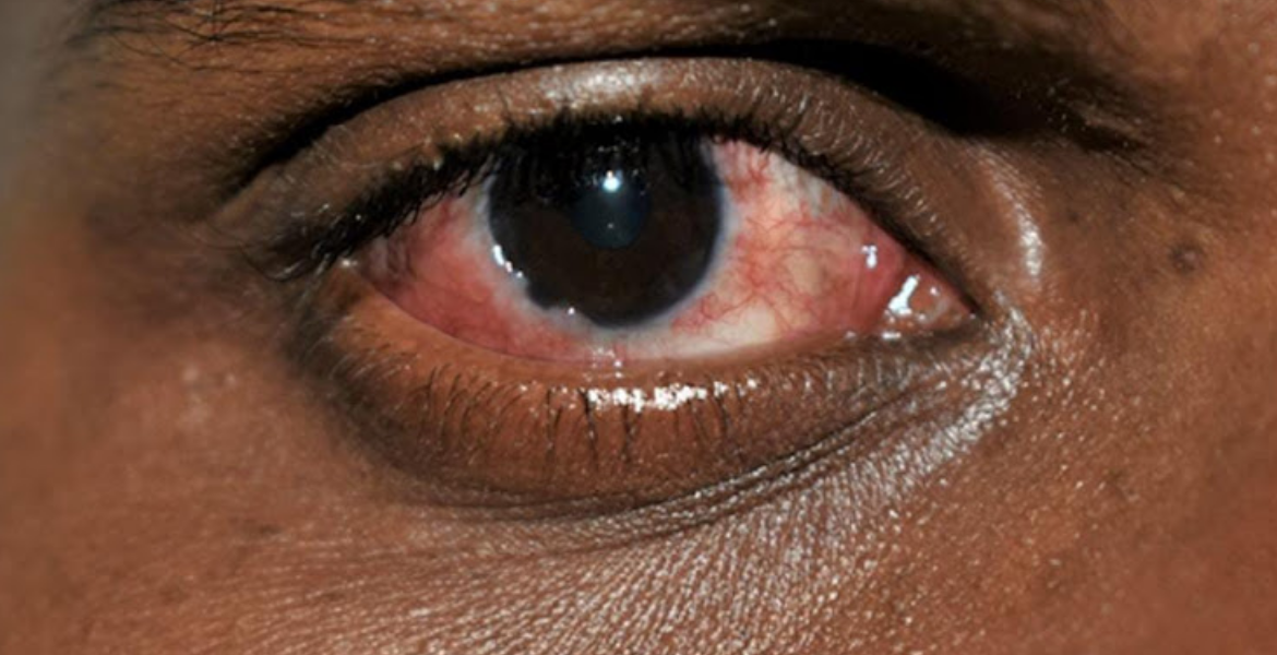 The Surge of Red Eye Disease in Kenya's Coast Region