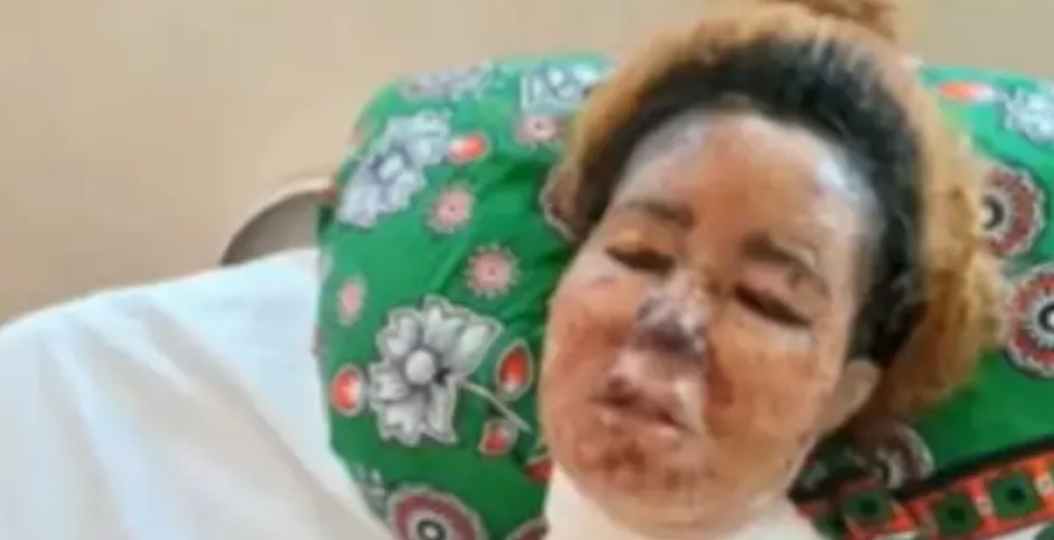 Mombasa Woman Fights for Her Life After Boyfriend Scalds Her Face with Boiling Oil