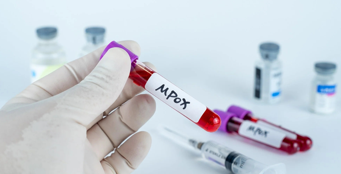 Kenya Intensifies Mpox Surveillance Amid Rising Cases