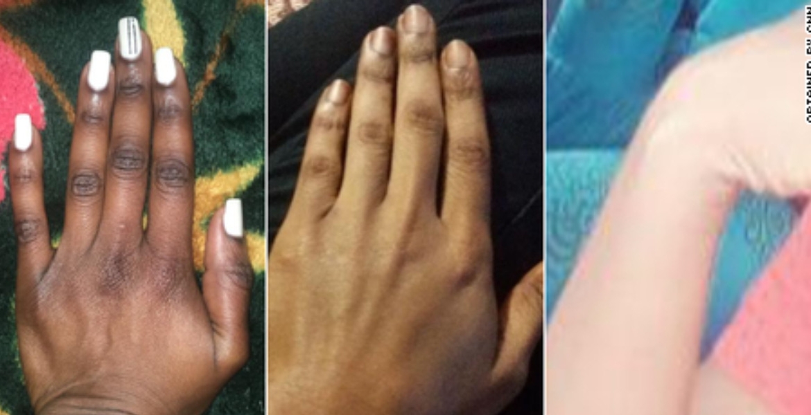 Kenya Battles Skin Bleaching Trend Despite Ban on 400 Dangerous Cosmetics